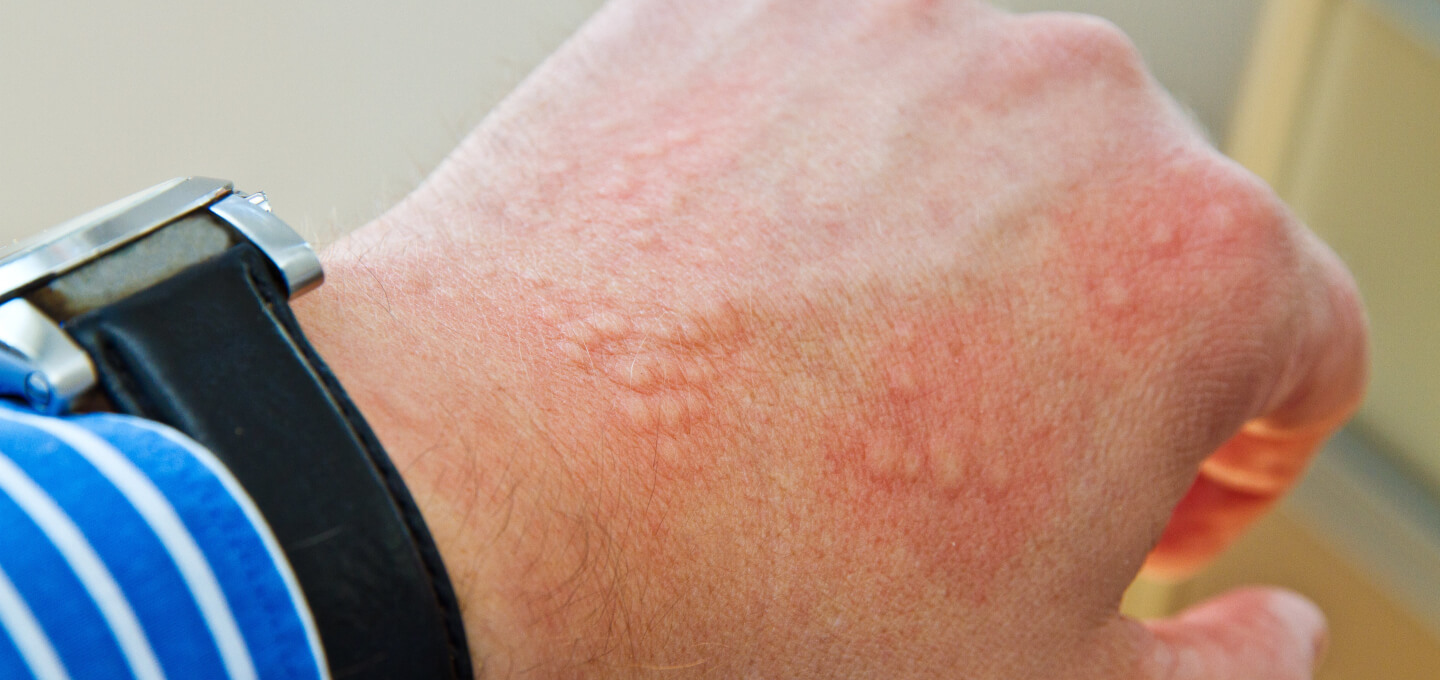Contact Dermatitis | Dermatology and Skin Health - Dr. Mendese