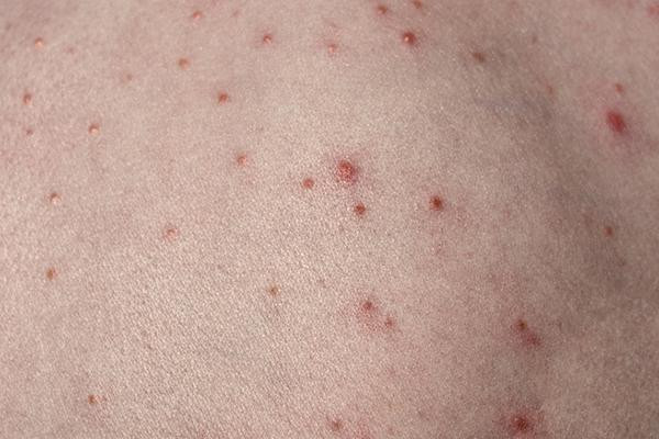 Folliculitis treatment and prevention - Harvard Health