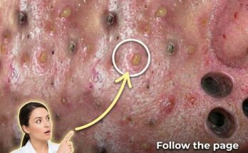 Fluctuating Hormones and the Skin: A Biological Look at Menstrual Breakouts