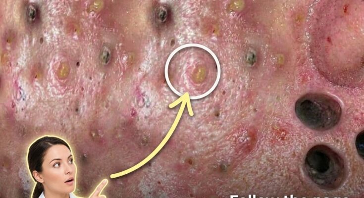 Fluctuating Hormones and the Skin: A Biological Look at Menstrual Breakouts