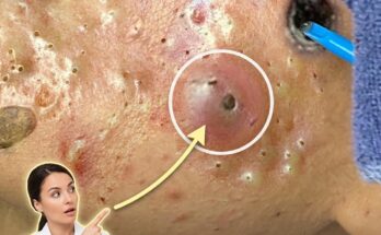 How Androgenic Hormones Influence Sebaceous Gland Activity and Drive Acne Development