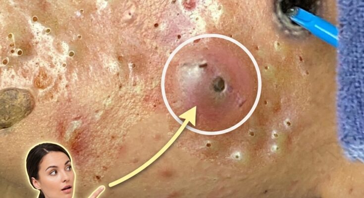 How Androgenic Hormones Influence Sebaceous Gland Activity and Drive Acne Development