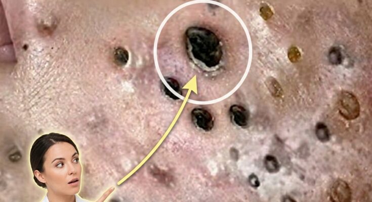 How Dead Skin Cells Interact with the Follicular System to Cause Pore