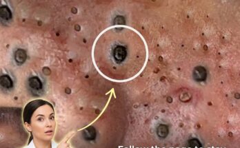 How Environmental Pollution Exacerbates Acne: A Biological Mechanism Deep Dive