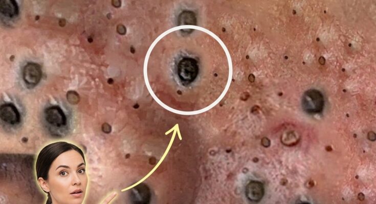 How Environmental Pollution Exacerbates Acne: A Biological Mechanism Deep Dive