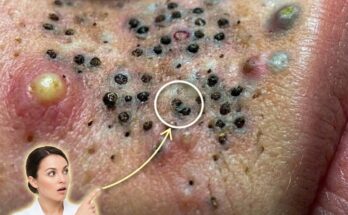 How High Atmospheric Humidity Influences Long-Term Acne Patterns