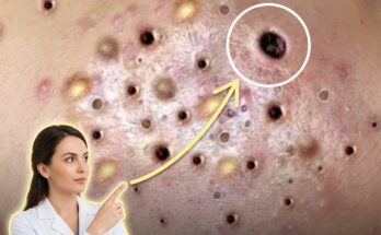 How Seasonal Climate Shifts Influence Oily Skin and Acne Dynamics