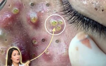 Understanding How Genetic Factors Influence Acne Severity and Treatment Pathways