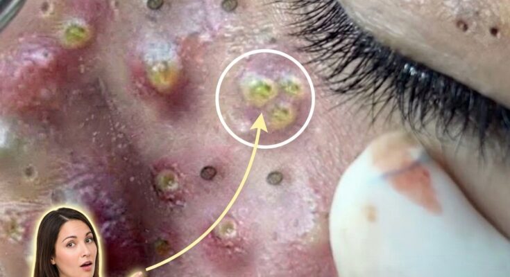 Understanding How Genetic Factors Influence Acne Severity and Treatment Pathways