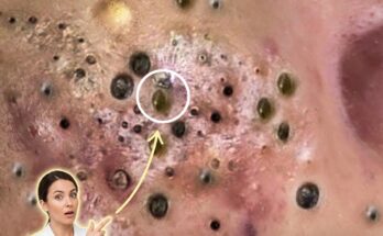 Understanding How Puberty Influences Long-Term Acne Dynamics and Skin Biology