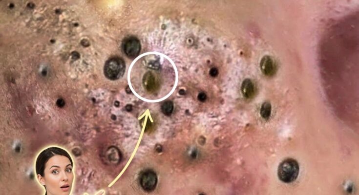 Understanding How Puberty Influences Long-Term Acne Dynamics and Skin Biology