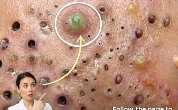 Understanding Stress Hormones, Ingredient Interactions, and Acne Clearance