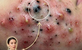 Understanding the Biological Differences Between Adult and Teenage Acne