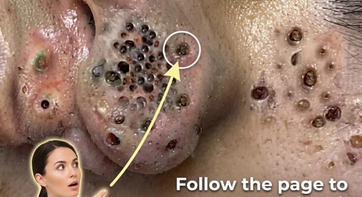 Understanding the Biological Link Between Excess Oil and Enlarged Pores