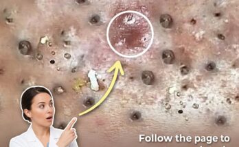 Understanding the Role of Skin Barrier Dysfunction in Acne Development