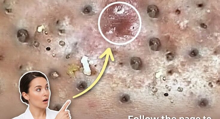 Understanding the Role of Skin Barrier Dysfunction in Acne Development