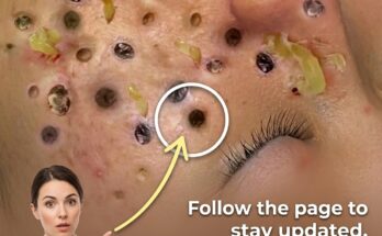 Understanding the Science of Sweat, Topical Ingredients, and Acne Formation