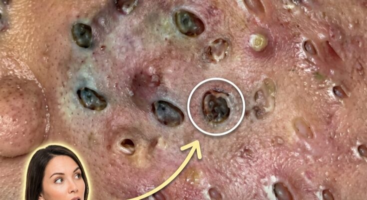 Why Acne Is Considered a Chronic Inflammatory Condition and the Role of